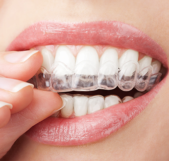 Clear Braces in Dumfries and Montclair, VA